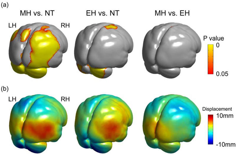 Comparación de la morfología de los cerebros de los neandertales (NT), los humanos modernos (MH) y los primeros H. sapiens (EH)