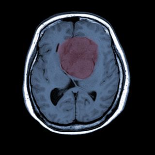 Los meningiomas, un tumor cerebral con buen pronostico