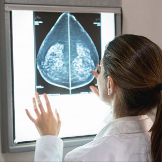 Nuevos hallazgos sobre el cáncer de mama