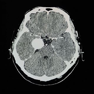 Meningiomas y otros tumores cerebrales