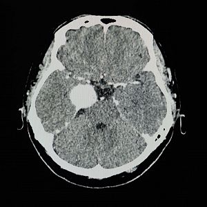 Entre probetas - Entre probetas - Meningiomas y otros tumores cerebrales - 30/04/24 - Escuchar ahora