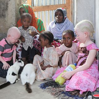 Asociación Beyond Suncare. El albinismo en África