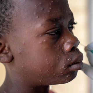 El 60% de casos de MPOX en África son menores de 15 años