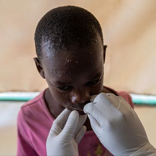 Burundi: consecuencias de la mpox en la infancia