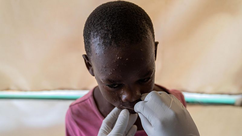 África hoy - Burundi: consecuencias de la mpox en la infancia - 28/10/24 - escuchar ahora