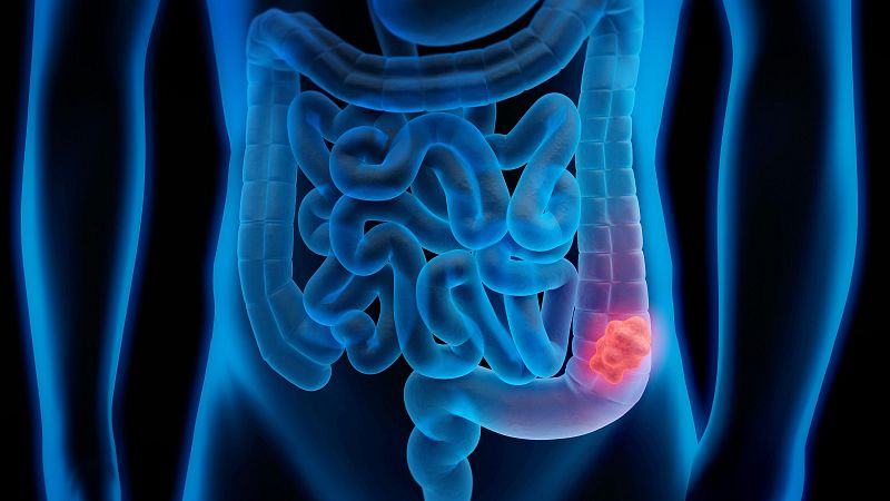 Marca España - Organoides, cáncer de colon y vitamina D - 19/12/24 - escuchar ahora