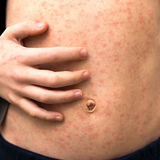 Sarampión, de los virus más contagiosos