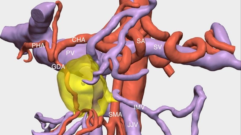 Nueva técnica para extirpar cánceres de páncreas inoperables