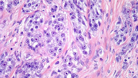 Reclamen ms recerca per combatre el sarcoma