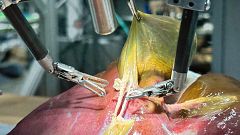 Investigadores de la Universidad John Hopkins realizan la primera cirugía autónoma asistida por ChatGPT