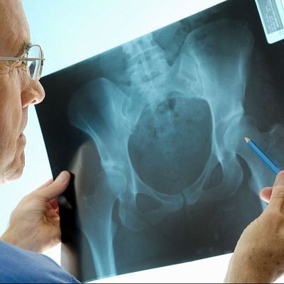 Osteoporosis: de los viejos mitos a los nuevos retos - Marca España | Escuchar