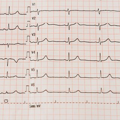 ¿España goza de buena salud cardiovascular? - Marca España | Escuchar