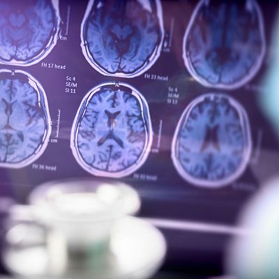 Alzheimer: cómo adaptar el sistema de salud a la enfermedad - Mediodía en RNE | Escuchar