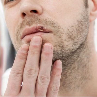 El herpes labial altera neuronas como el alzhéimer - A golpe de bit | Escuchar