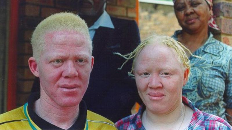 Entre paréntesis - La terrible realidad de los albinos africanos - Escuchar ahora