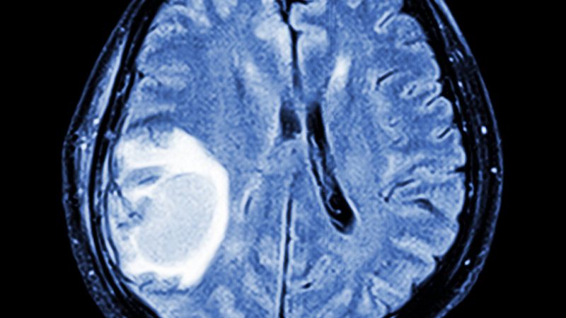 España vuelta y vuelta - Un nuevo sistema para operar tumores cerebrales que afectan a áreas funcionales - Escuchar ahora