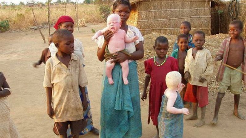 Entre paréntesis - Albinismo, un trastorno genético que puede llevar a la muerte - Escuchar ahora
