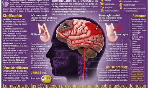 Radio 5 Actualidad - El ictus, una enfermedad cerebral, segunda causa de muerte en España - Escuchar ahora
