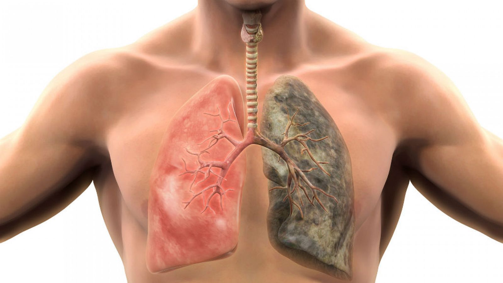 Entre paréntesis - El tabaco, principal reponsable del cáncer de pulmón - Escuchar ahora