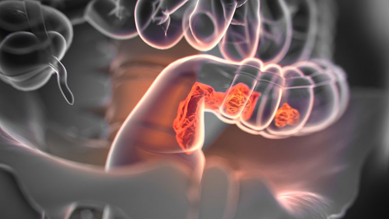El cáncer de colon, el más frecuente en España y el que más se cura