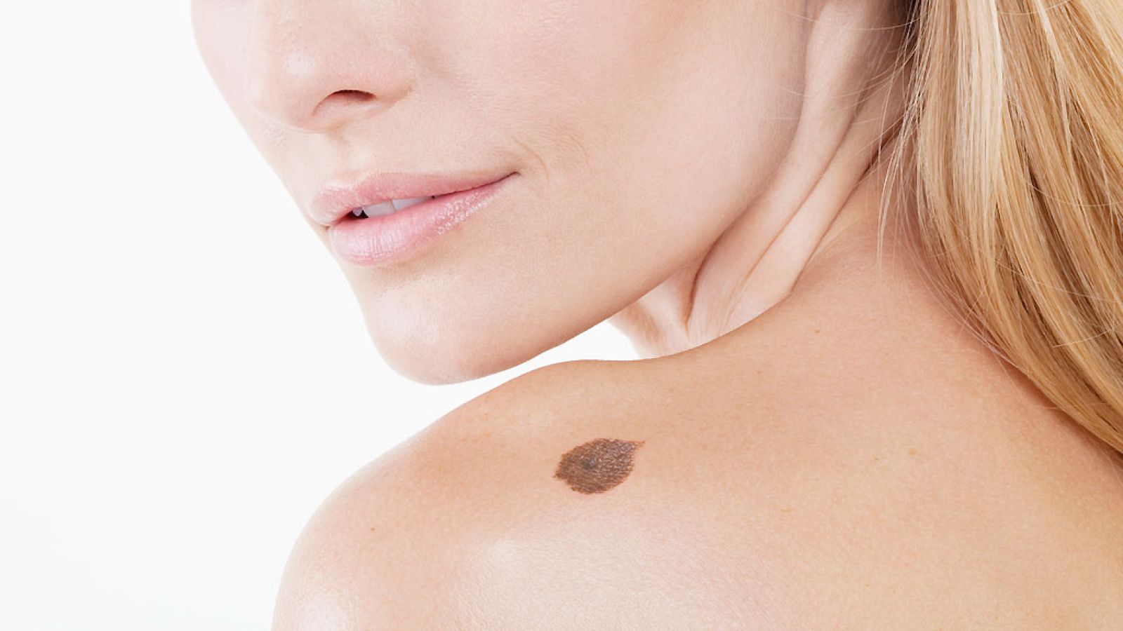 El canto del grillo - La prevención del melanoma - Escuchar ahora 