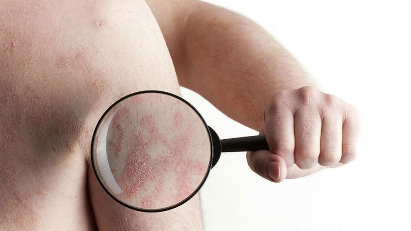  Todo Noticias - Mañana - Día Mundial de la psoriasis que sufren más de un millón de personas - Escuchar ahora