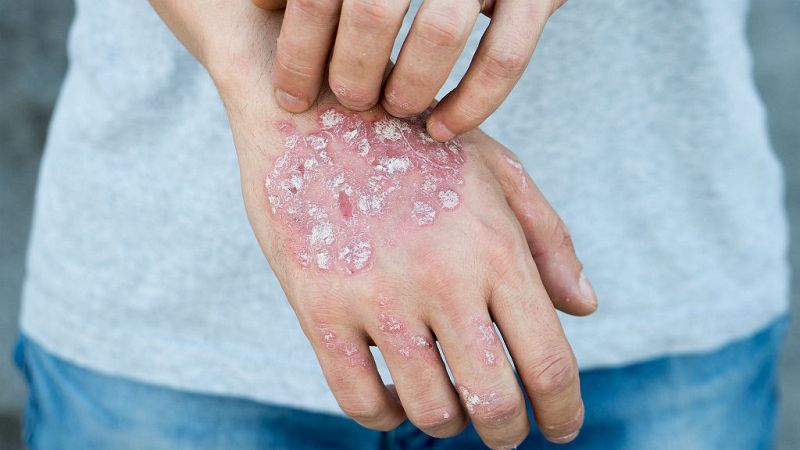 14 horas - Día Mundial de la Psoriasis, una enfermedad que sufre un millón de personas en España - Escuchar ahora