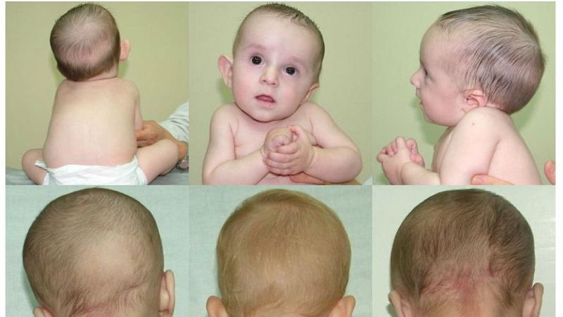 Mamás y papás - Plagiocefalia, un problema que trae de cabeza - 26/01/19 - Escuchar ahora 