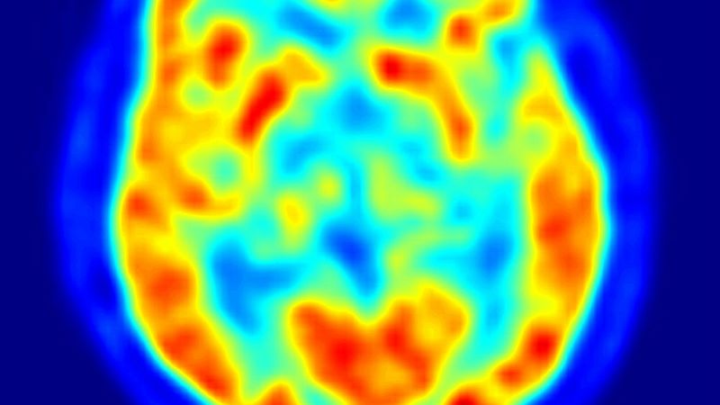Cuaderno mayor - Avanza el estudio para pacientes con Parkinson y demencia asociada - 12/03/19 - Escuchar ahora