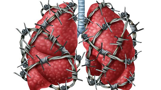 A su salud - A su salud - Tuberculosis: es hora de actuar - 22/03/19 - escuchar ahora