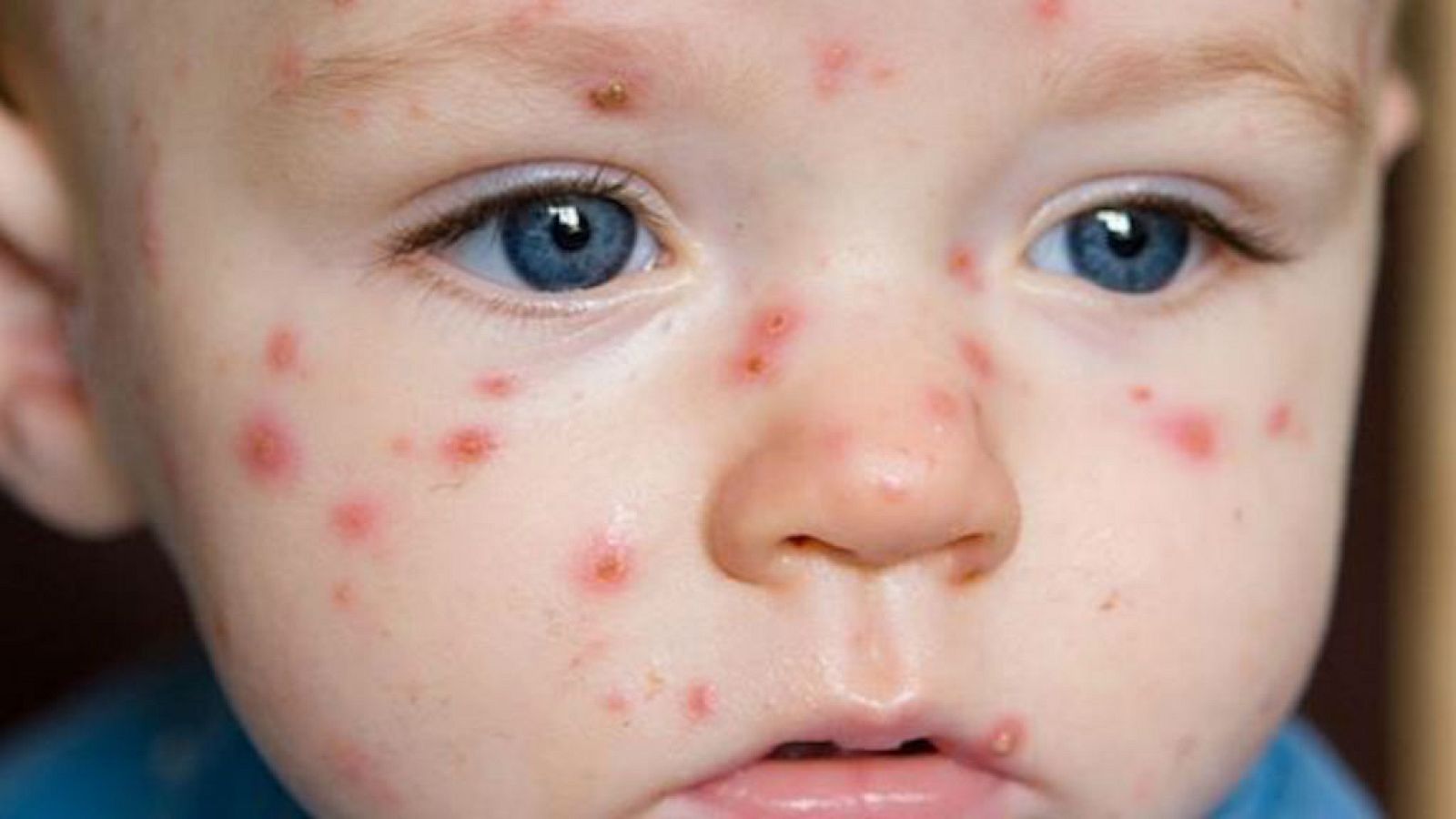  Boletines RNE - Trump pide que se vacune contra el Sarampión por temor a epidemias  - escuchar ahora