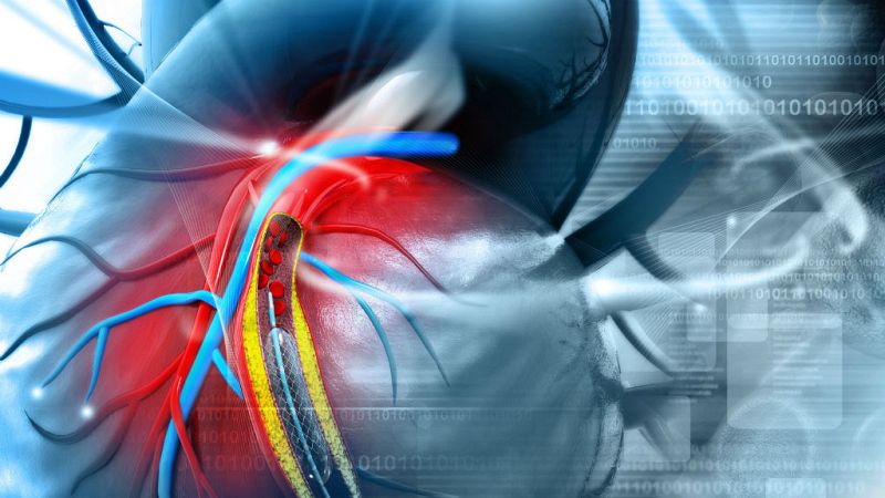 14 horas - ¿Qué es un stent? Ahora Casillas lleva uno en el corazón - Escuchar ahora