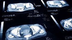 A su salud - Cáncer de próstata e incontinencia urinaria - 31/05/19