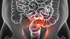 Médico de guardia: "Cáncer colorrectal"