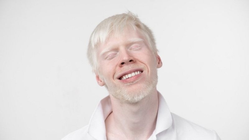 Para que veas - Albinismo sin limitaciones, con normalidad - 07/10/19 - Escuchar ahora