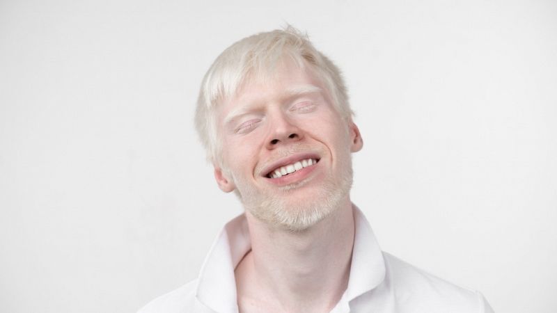 Para que veas - Albinismo sin limitaciones, con normalidad - 07/10/19 - Escuchar ahora