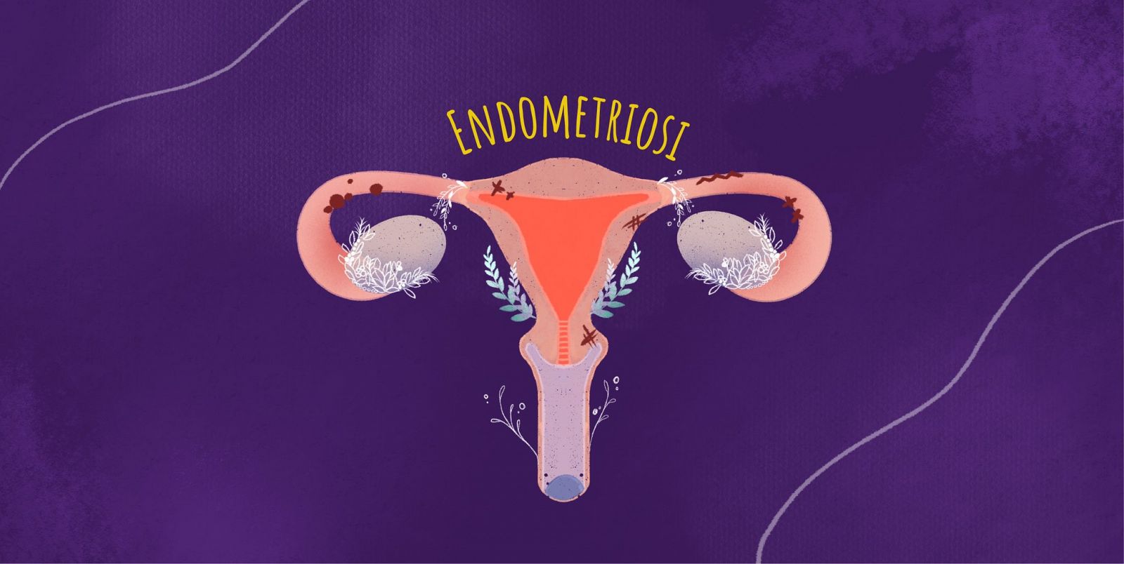 Feminismes a Ràdio 4 - Endometriosi