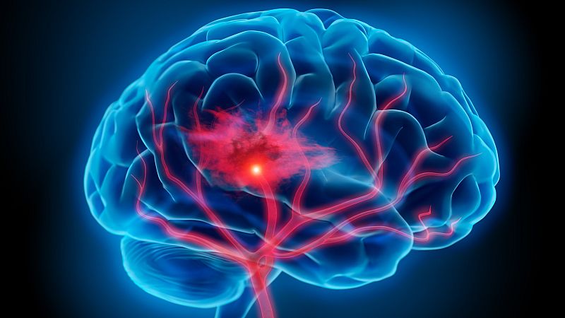Más cerca - El ictus, una enfermedad poco visible pero muy prevalente - Escuchar ahora 