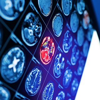 Enfermedades priónicas. Luchar contra la bomba atómica 