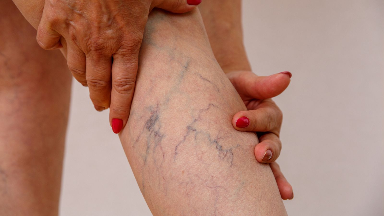 Enfermera saturada - Varices - Escuchar ahora