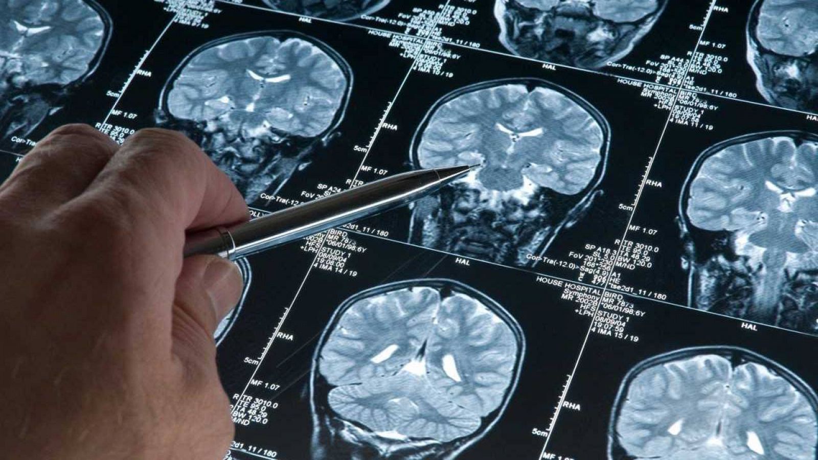 Un nou fàrmac immunològic es mostra eficaç en el tractament del tumor cerebral més comú