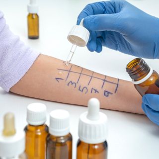 Mi alergia es un calvario