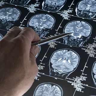 "El nuevo fármaco permite cronificar este tumor cerebral"
