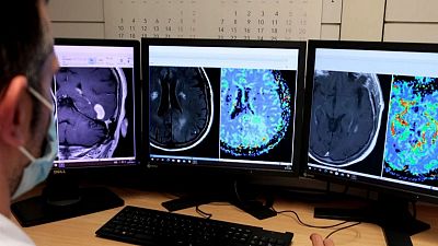 Científics dissenyen una nova eina d'intel·ligència artificial per al diagnòstic de tumors cerebrals