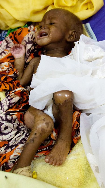 Niño con graves afecciones cutáneas a causa de la desnutrición se retuerce de dolor en su cama del Hospital de Zinder (Níger).