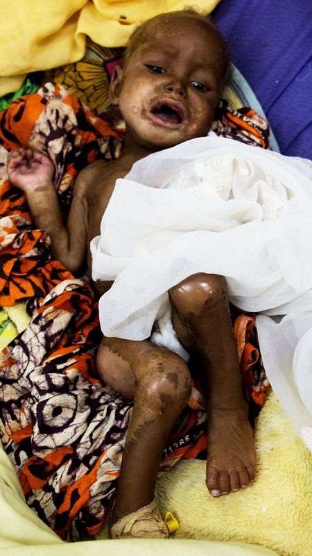 Niño con graves afecciones cutáneas a causa de la desnutrición se retuerce de dolor en su cama del Hospital de Zinder