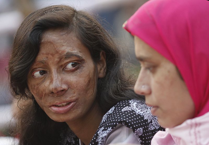Mujer superviviente del ataque de los ácidos de su pareja participa en un mitin de la conciencia sobre la violencia contra las mujeres en Dhaka, Bangladesh.