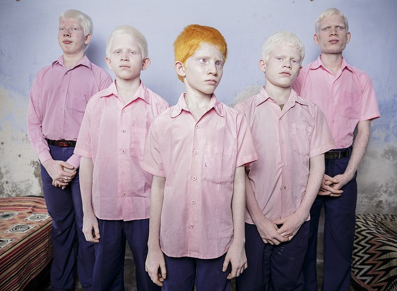 Brent Stirton, primer premio individual reportaje retratos. Niños indios albinos ciegos