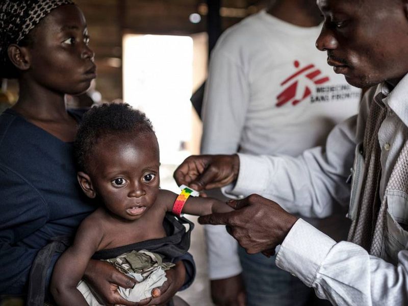 Los médicos utilizan la medición del perímetro del brazo para determinar si el niño está desnutrido.