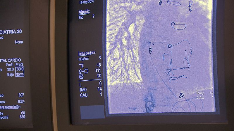 El catéter es un tubo de pocos milímetros de diámetro que se introduce a través de una vena o una arteria